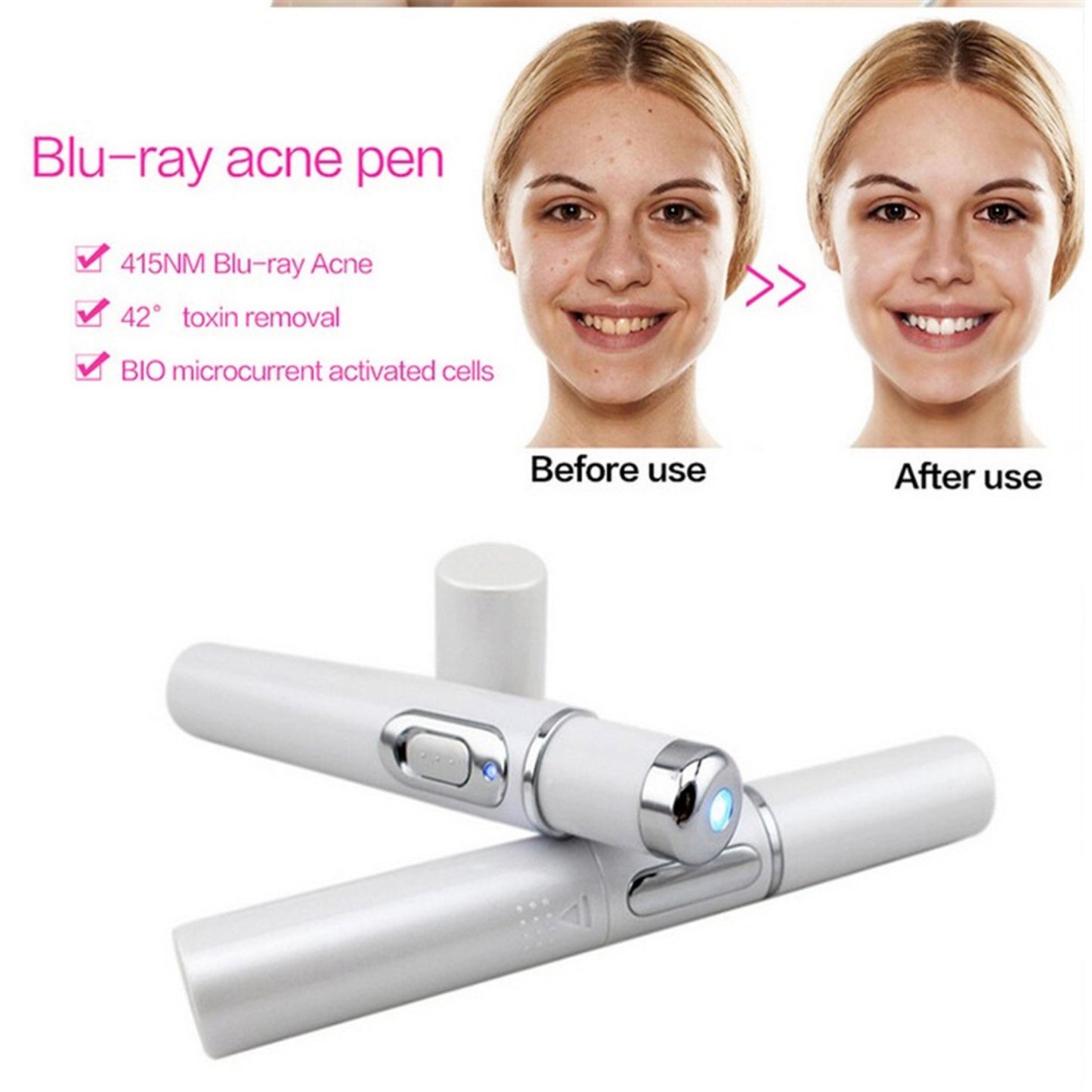Acne Removal Laser Pen – Blue Light Therapy for Clear & Smooth Skin