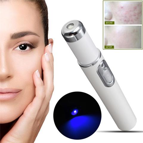 Acne Removal Laser Pen – Blue Light Therapy for Clear & Smooth Skin