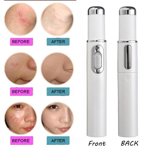 Acne Removal Laser Pen – Blue Light Therapy for Clear & Smooth Skin